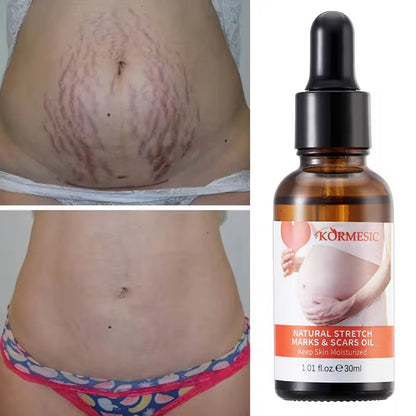 Stretch Mark Repair Oil – Nourishing Care for Stretch Marks & Scars